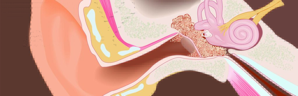 χολοστεάτωμα εικόνα